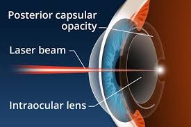 Image result for polishing an implanted lens