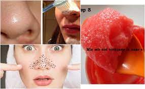 20 home remes to remove blackheads