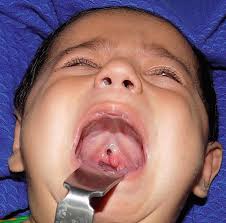 submucous cleft palate for langenbeck