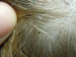 As mentioned previously, it is easier to detect head lice and their lice eggs in blonde hair than in other hair colors. What Do Lice Look Like The Video Is Kinda Gross But Necessary