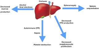 Among the many liver disorders that can lead to cirrhosis, some. Thrombocytopenia In Cirrhosis A Review Of Pathophysiology And Management Options Moore 2019 Clinical Liver Disease Wiley Online Library