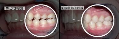 Surgery is often recommended as the only option when braces failed. Non Surgical Treatment To Correct Overbites Underbites Konig Center For Cosmetic Comprehensive Dentistry