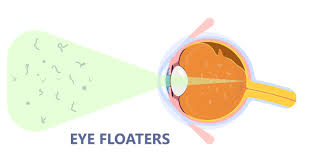 are flashes and floaters a cause for
