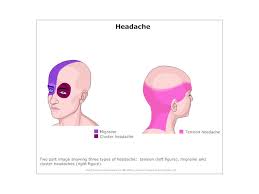 Migraine Headache Charts And Diagrams Wow Profit Packs