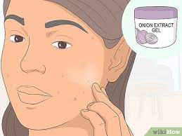 how to get rid of acne scars can