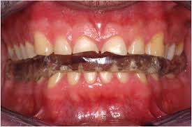 restorative treatment of tooth wear