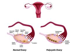 polycystic ovarian syndrome nevada