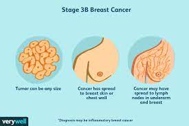 Enlarge anatomy of the female reproductive system. Stage 3 Breast Cancer Types Treatment Survival