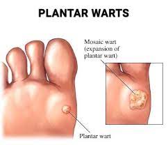plantar wart treatment foot