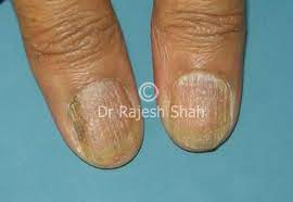 lichen pl of nails causes