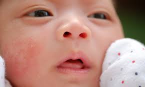 baby acne what causes it and how to