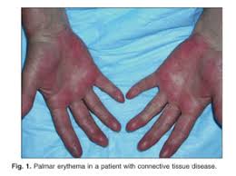 It can also be found on the soles of the feet, when it is termed plantar erythema. Gale Academic Onefile Document Palmar Erythema