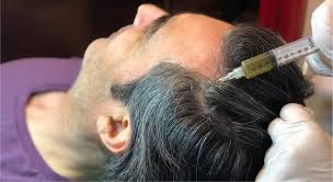 prp hair restoration v beauty spa