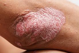 plaque psoriasis causes triggers and