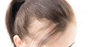 اسباب تساقط الشعر عند النساء وعلاجه
