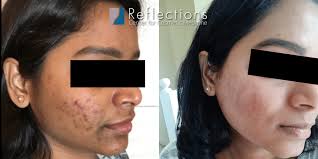 acne scars before after photos new