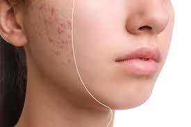 how acne scars form stone oak dermatology