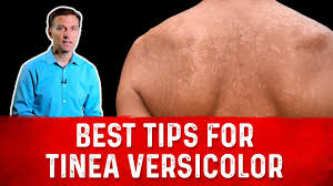 best tips for tinea versicolor