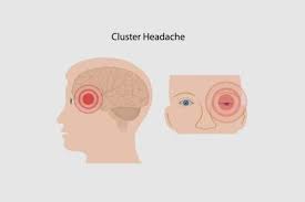 Cluster Headaches Overview Of Symptoms Causes And Treatment