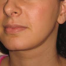 We did not find results for: Vaser Chin And Neck Liposuction Jag Chana