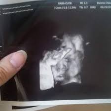 cleft lip in 3d ultrasound babycenter