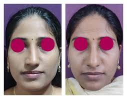 rhinoplasty cost in india nose job