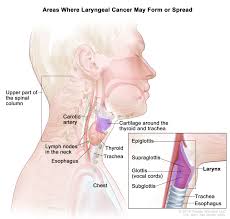Cancerous tumors can be of various kinds. Throat Laryngeal Cancer Dana Farber Cancer Institute Boston Ma
