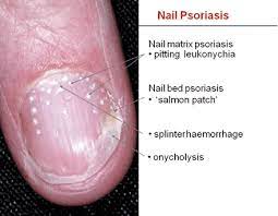managing patients with nail psoriasis