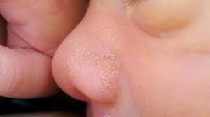 baby acne causes symptoms and treatment