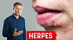 eat and avoid if you have herpes