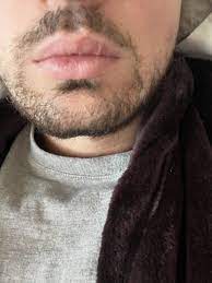 split lip scar raised lip scar photos