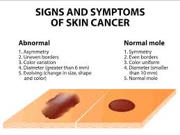 Here's what it may look like: Skin Cancer Symptoms And Signs Cancerbro