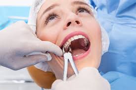 tooth extraction what to expect during