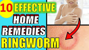 10 effective home remes for ringworm