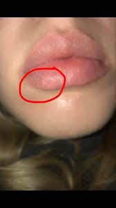 dry patch on lips that won t go away