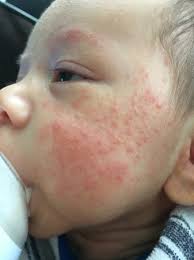 baby acne eczema heat rash babycenter