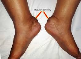 Insertional achilles tendinopathy retrocalcaneal bursitis haglund deformity (i.e. Haglund S Syndrome Causes Symptoms Diagnosis Treatment
