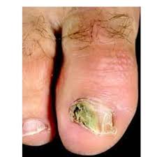 toes nail fungus treatment at best