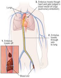 Thromboembolism Deep Vein Thrombosis And Pulmonary Embolism