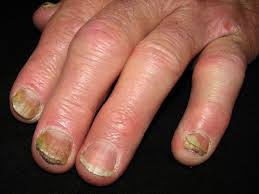 psoriatic arthritis nails signs