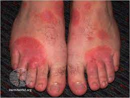 eczema hand and foot refhelp