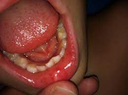 rash inside toddler mouth advice