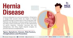 hernia symptoms types causes