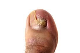 fungal toenails treatment podiatrist