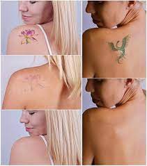 Tattoo removal is the removal of tattoos from the skin of the body. 13 Best Tattoo Removal Methods And How To Remove Tattoo I Fashion Styles