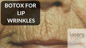botox for lip wrinkles you