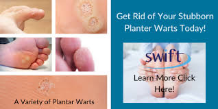 are plantar warts itchy foot and