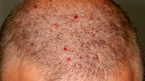 folliculitis scalp symptoms pictures