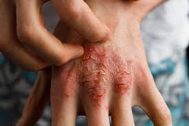 psoriasis hide flare ups and patches
