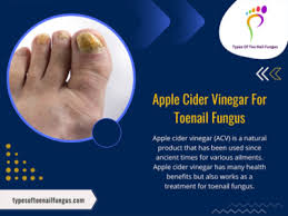 apple cider vinegar for toenail fungus